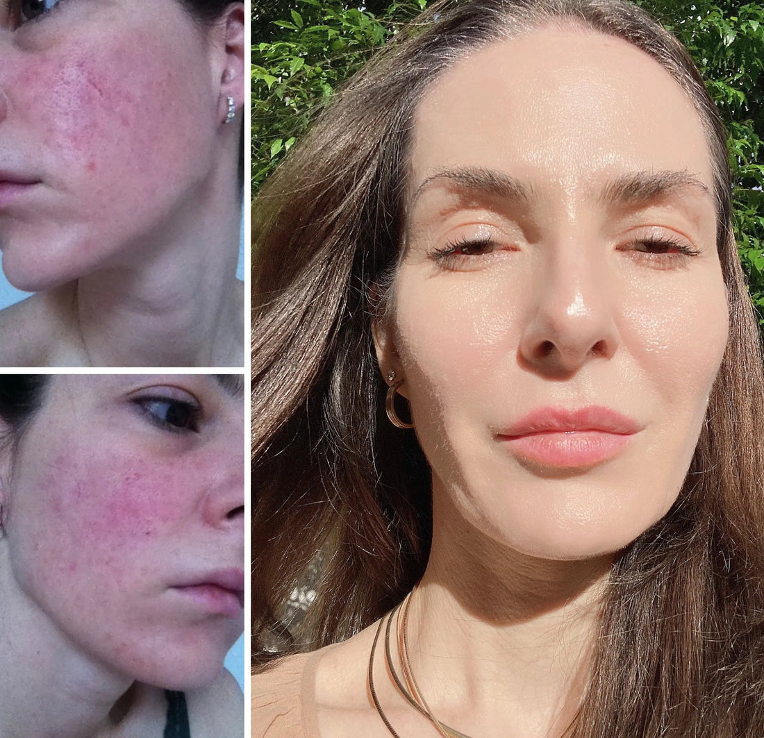 Rosacea Solutions