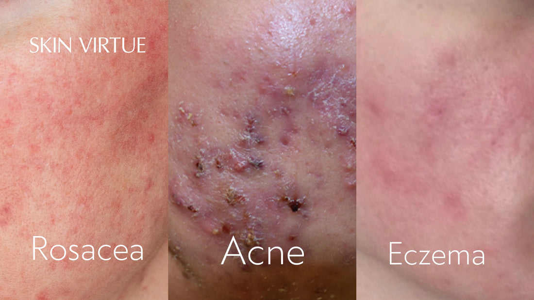 Rosacea, eczema, acne, and post-treatment inflammation