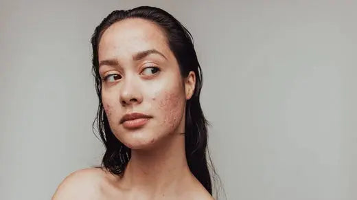 How-to-Manage-Adult-Acne Skin Virtue