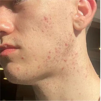 Skin Virtue before and after skincare results - image 10