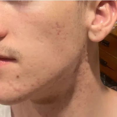 Skin Virtue before and after skincare results - image 11