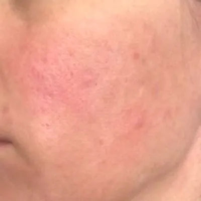 Skin Virtue before and after skincare results - image 17