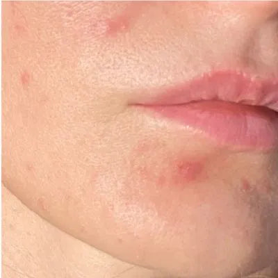 Skin Virtue before and after skincare results - image 19