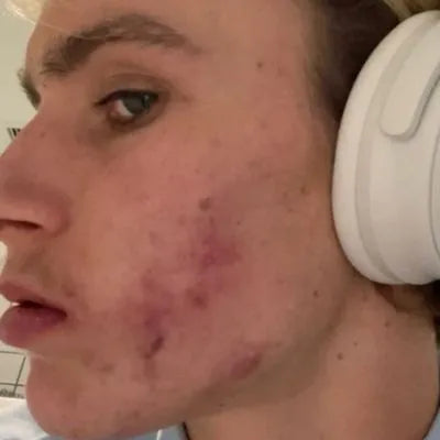 Skin Virtue before and after skincare results - image 21