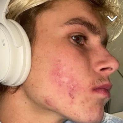 Skin Virtue before and after skincare results - image 22