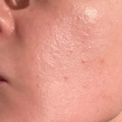 Skin Virtue before and after skincare results - image 24