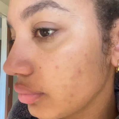 Skin Virtue before and after skincare results - image 3