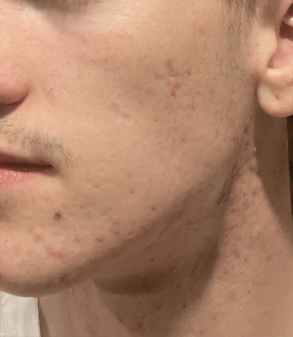 Before | Acne Prone and Congested Skin