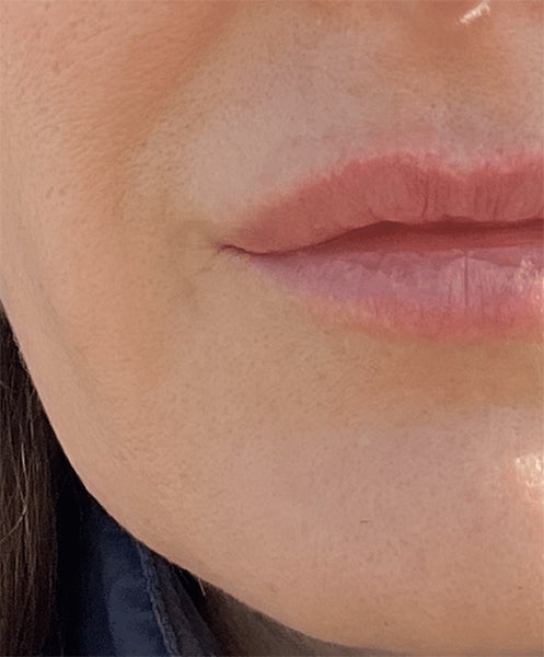 Discolouration and Redness | After